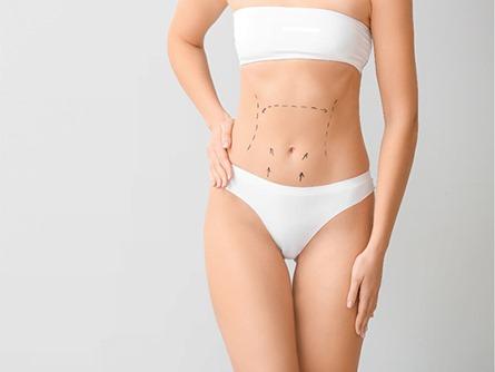 Tummy Tuck